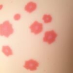 keto rash health concerns